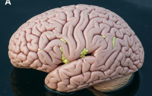 مغز دلفین‌های به گل نشسته، نشانه‌هایی از بیماری آلزایمر رو نشون داده